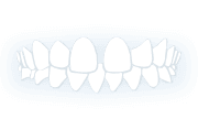 Niềng Răng Trong Suốt 10 teeth gap