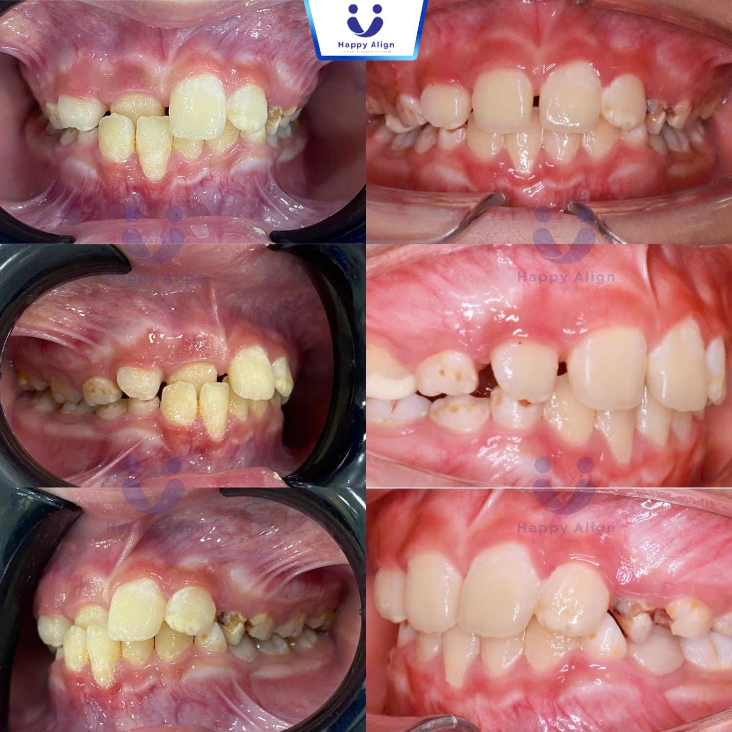 Happy algin truonghop 1