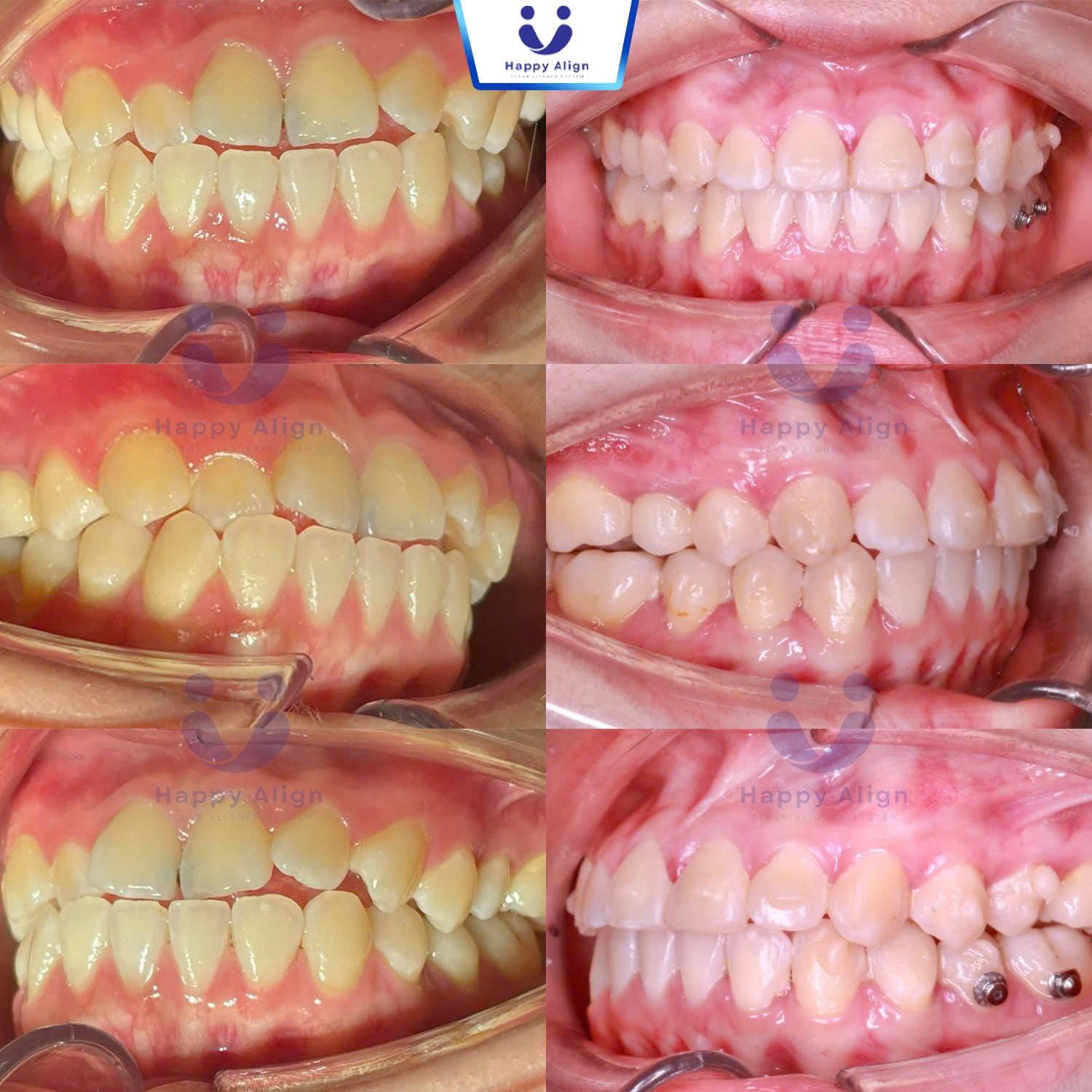 Happy algin truonghop 2