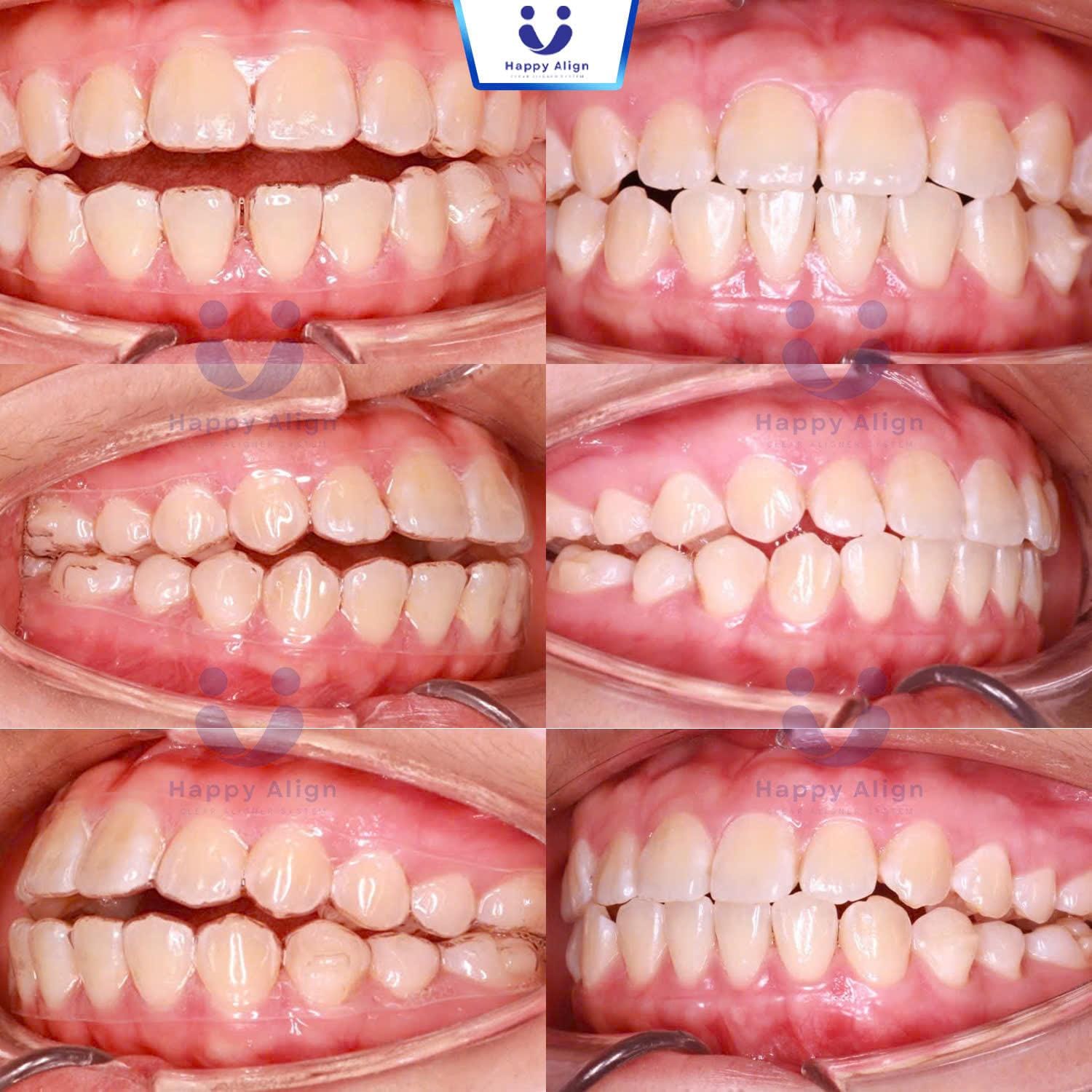 Happy algin truonghop 3