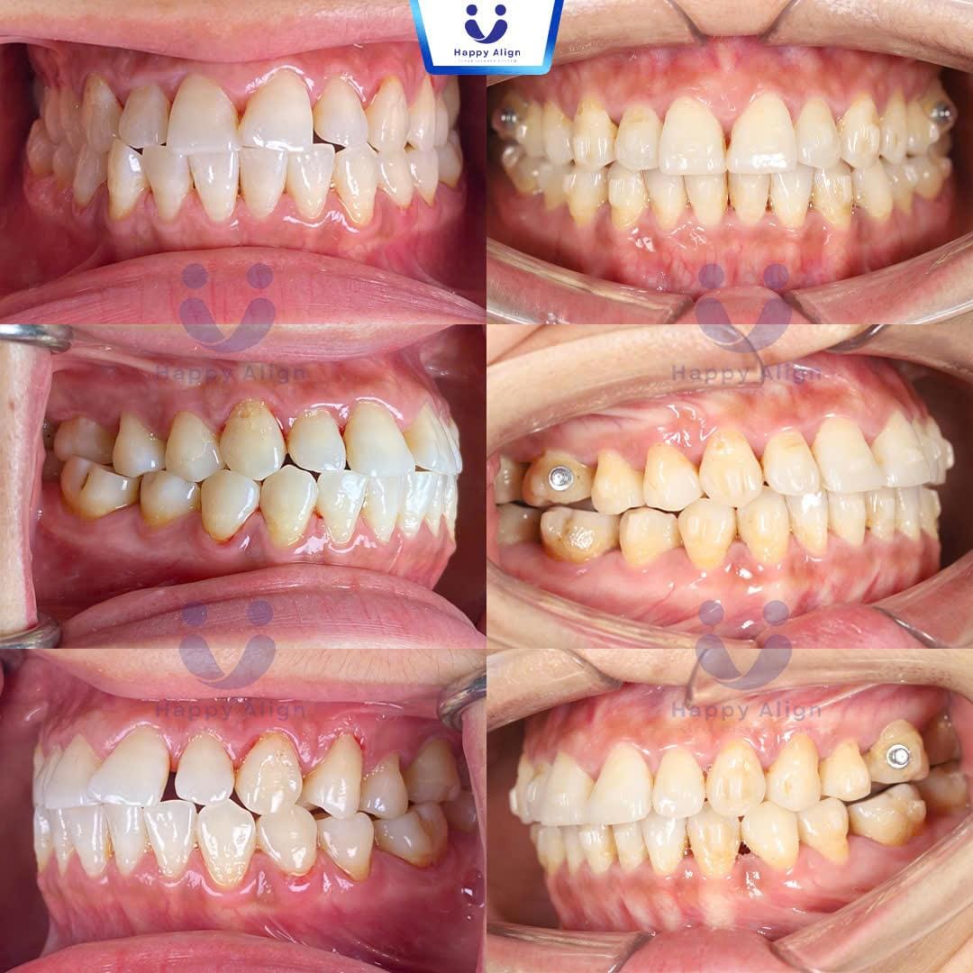 Happy algin truonghop 5