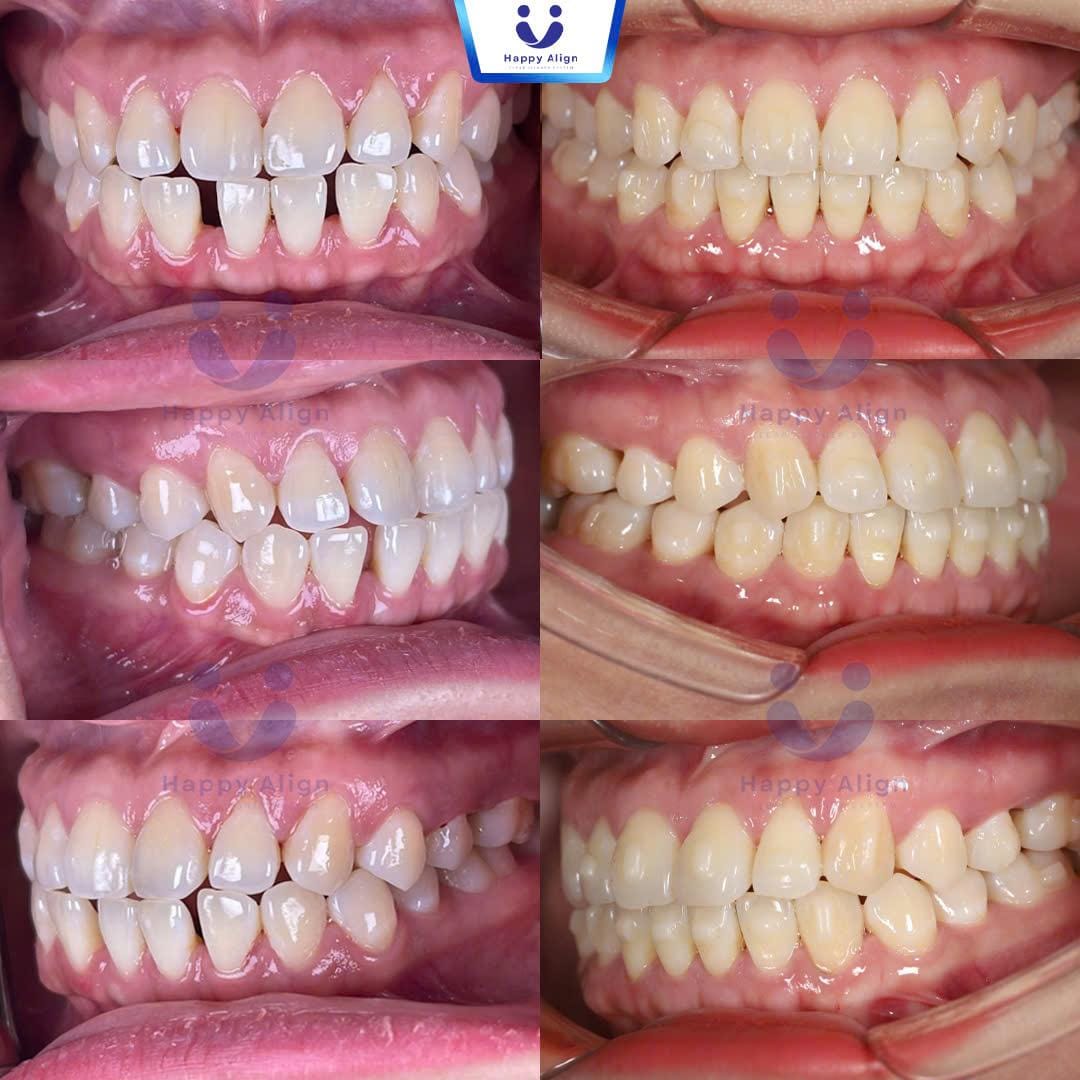 Happy algin truonghop 6