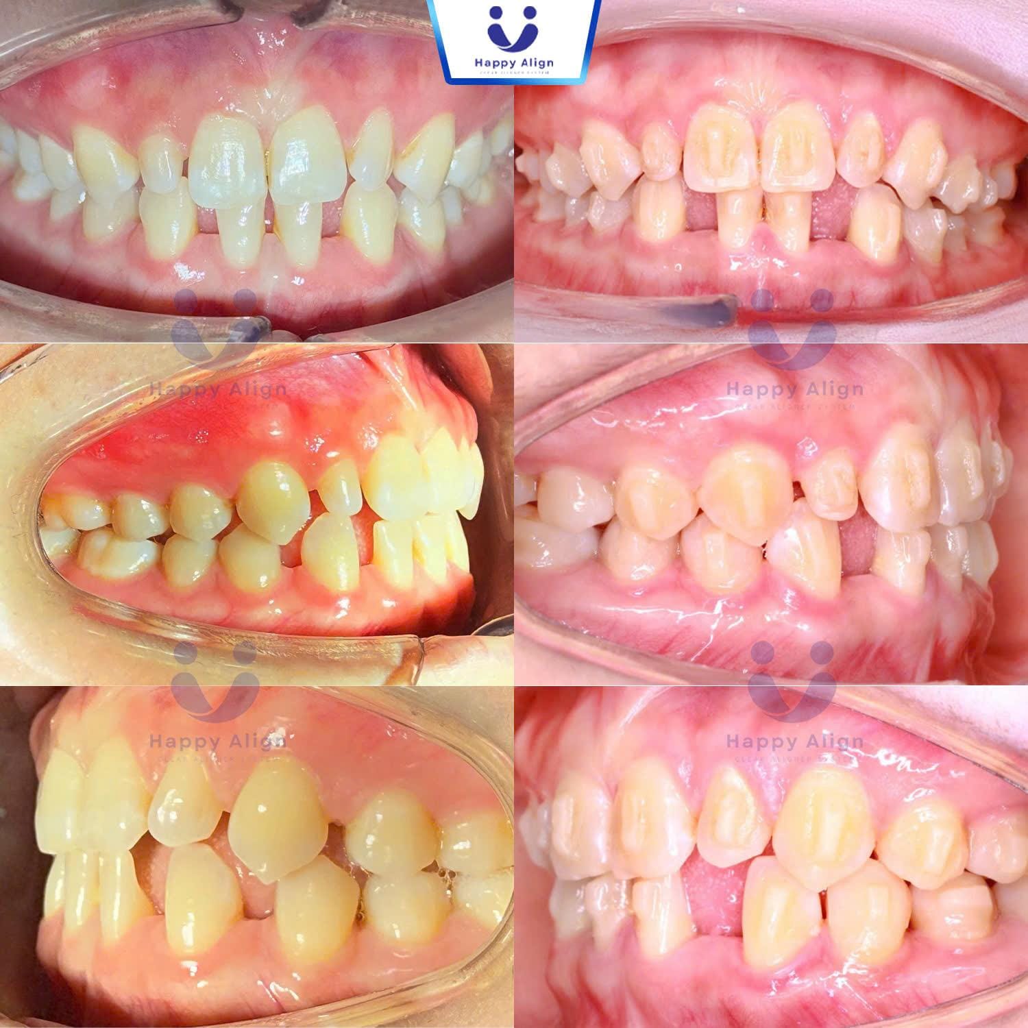 Happy algin truonghop 8