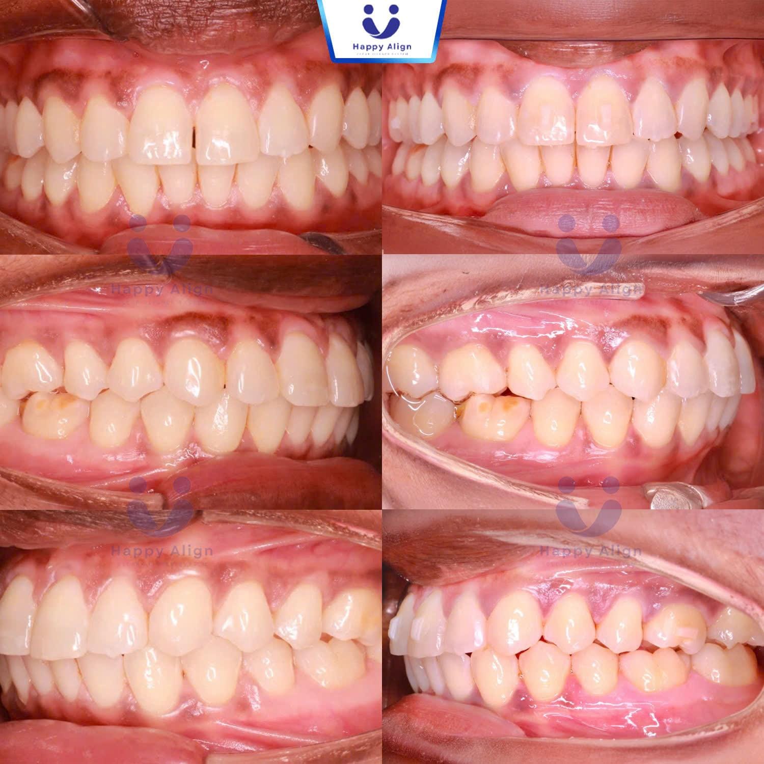 Happy algin truonghop 9